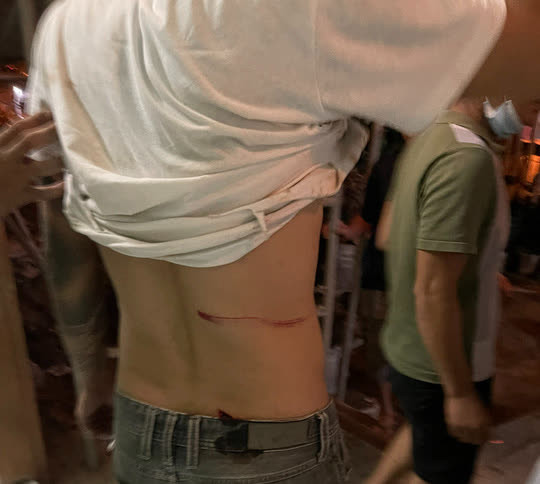 Một thanh niên bị nhóm đối phương chém vào vùng thắt lưng Một thanh niên bị nhóm đối phương chém vào vùng thắt lưng