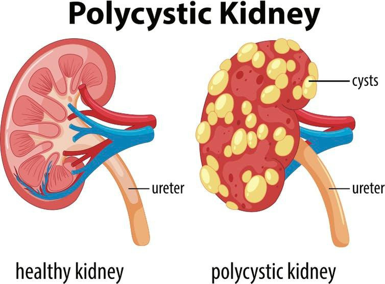 Bệnh thận đa nang là tình trạng xuất hiện các u nang nhỏ chứa đầy chất lỏng trong thận, khiến thận to bất thường, làm tổn thương mô thận. Ảnh: Shutterstock