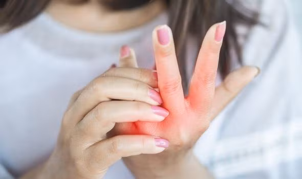 Loại phát ban như rôm sảy do nóng, có xu hướng xuất hiện nhiều hơn trên bàn tay, bàn chân và khuỷu tay. Minh họa: Shutterstock