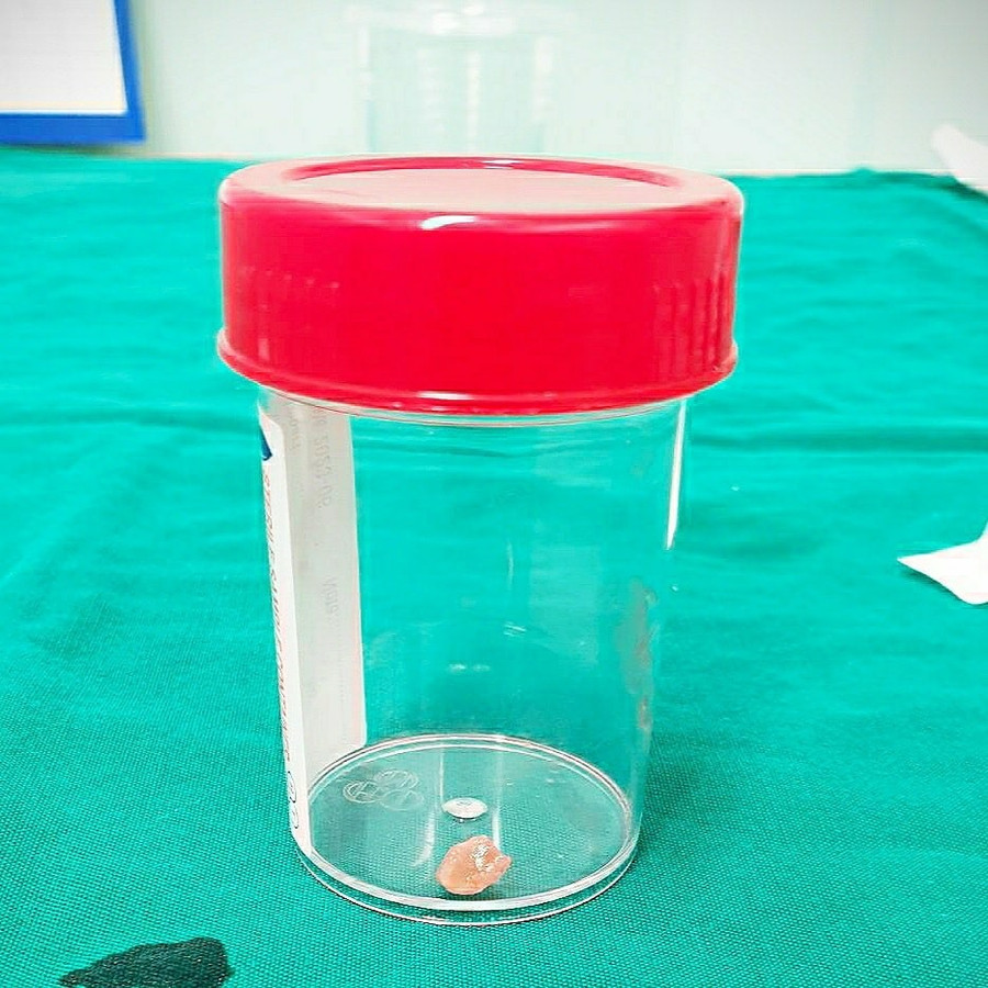 Dị vật là hạt đậu phộng sau khi được gắp ra ngoài. Dị vật là hạt đậu phộng sau khi được gắp ra ngoài.