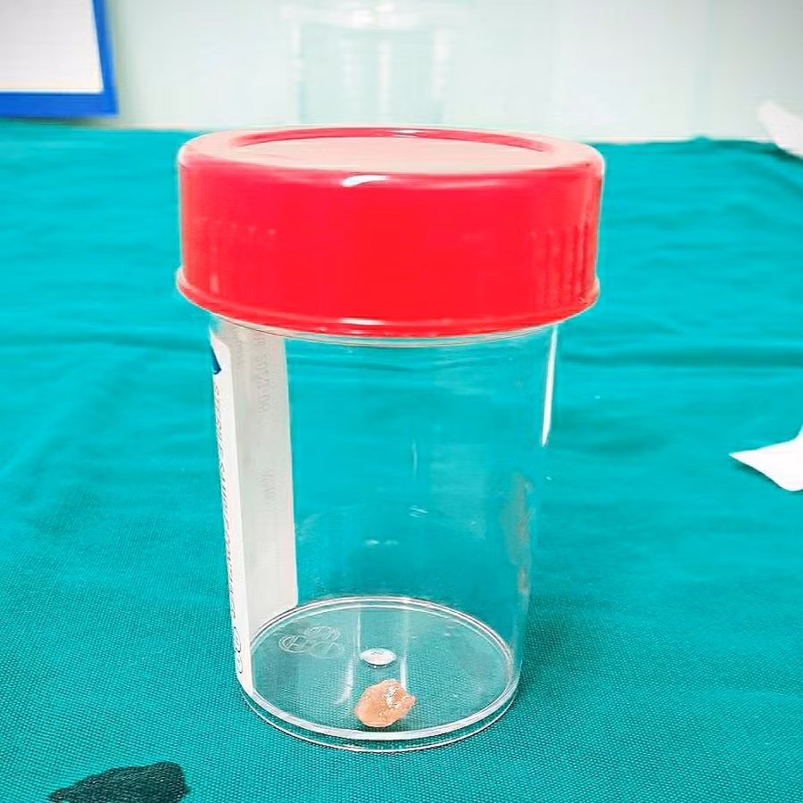  Dị vật là hạt đậu phộng sau khi được gắp ra ngoài.