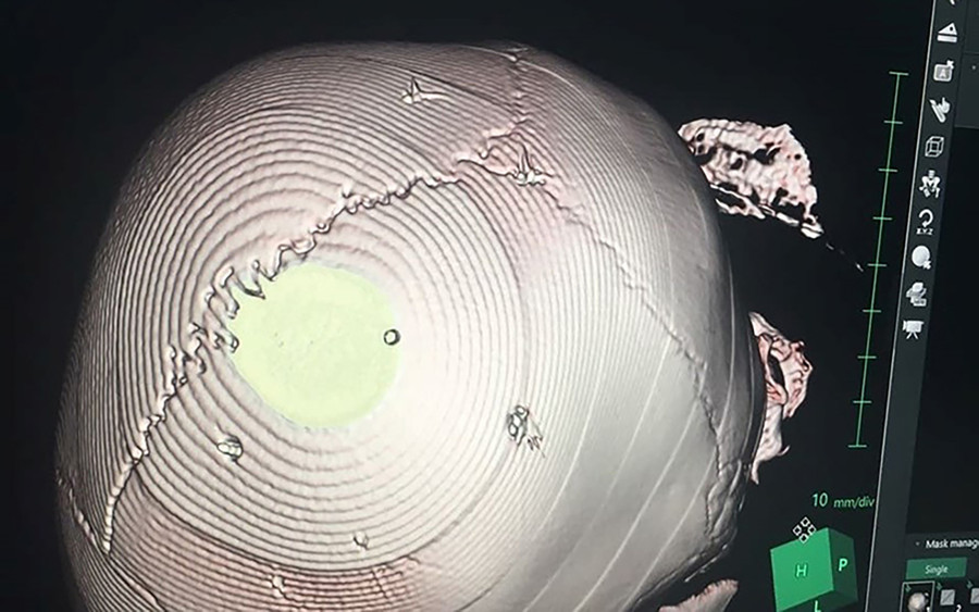 Những vết đinh trên đầu bé gái 3 tuổi. Ảnh: BVCC