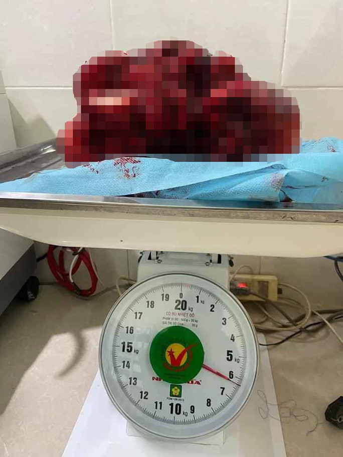 Khối u hơn 6kg lấy ra từ bụng sản phụ Khối u hơn 6kg lấy ra từ bụng sản phụ