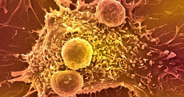 Hình ảnh quét vi điện tử của các tế bào miễn dịch tấn công ung thư. Ảnh: Getty.