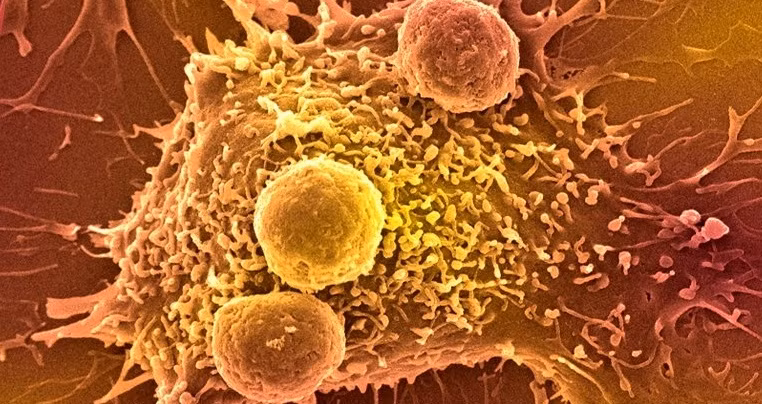 Hình ảnh quét vi điện tử của các tế bào miễn dịch tấn công ung thư. Ảnh: Getty.