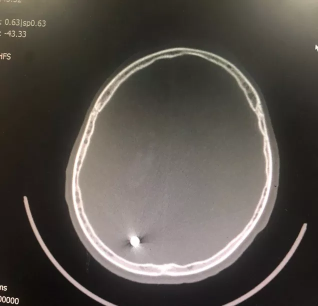 Phim chụp vết thương với viên đạn xuyên qua não bệnh nhân - Ảnh: Bác sĩ cung cấp