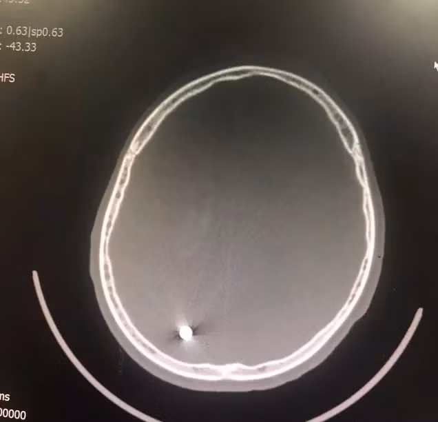 Phim chụp vết thương với viên đạn xuyên qua não bệnh nhân - Ảnh: Bác sĩ cung cấp