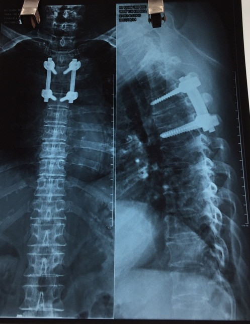 Vị trí can thiệp cứu vận động cho cụ H.