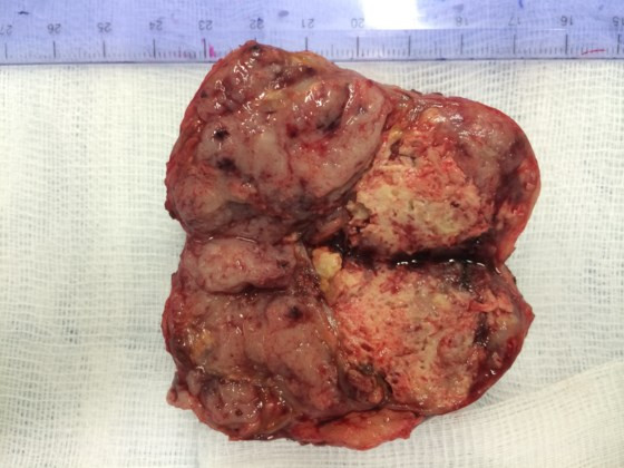  Khối u sau khi phẫu thuật cắt bỏ