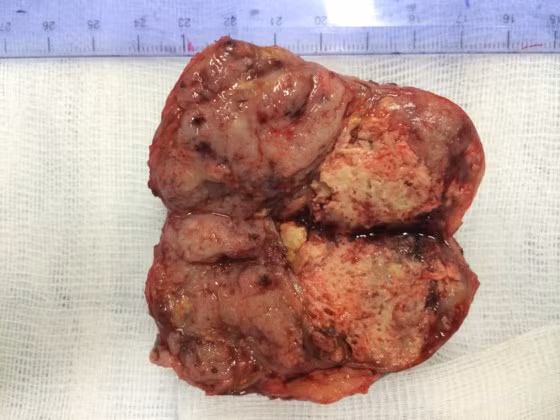  Khối u sau khi phẫu thuật cắt bỏ