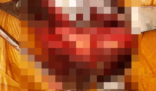 Phẫu thuật lấy mảng xơ vữa cho bệnh nhân P. Ảnh: TIẾN ĐỨC