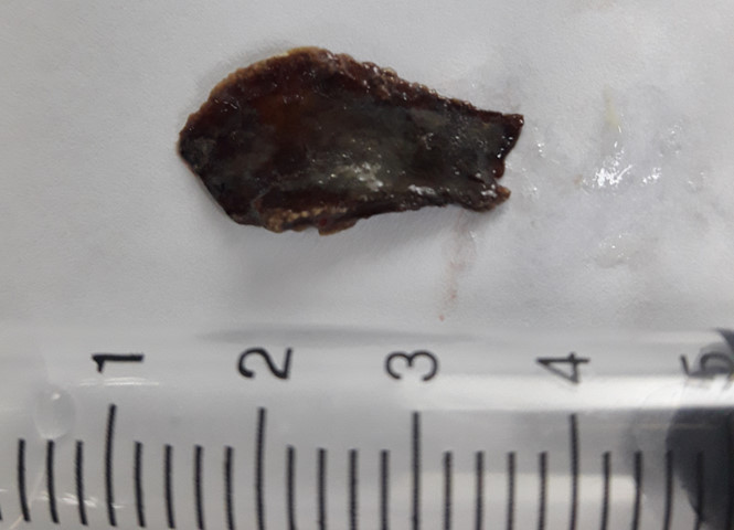 Dị vật được gắp ra khỏi cơ thể ông C. sau 4 năm khu trú, hành hạ. Dị vật được gắp ra khỏi cơ thể ông C. sau 4 năm khu trú, hành hạ.