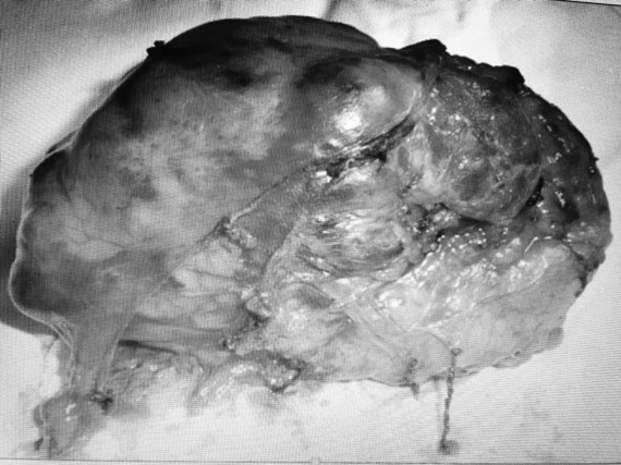 Khối u sau khi được lấy ra khỏi cơ thể bệnh nhân