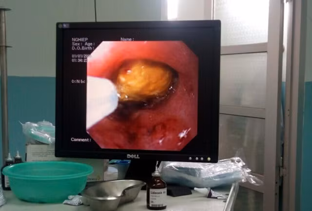 Hình ảnh siêu âm phát hiện hạt măng cụt trong dạ dày bệnh nhân nữ Hình ảnh siêu âm phát hiện hạt măng cụt trong dạ dày bệnh nhân nữ