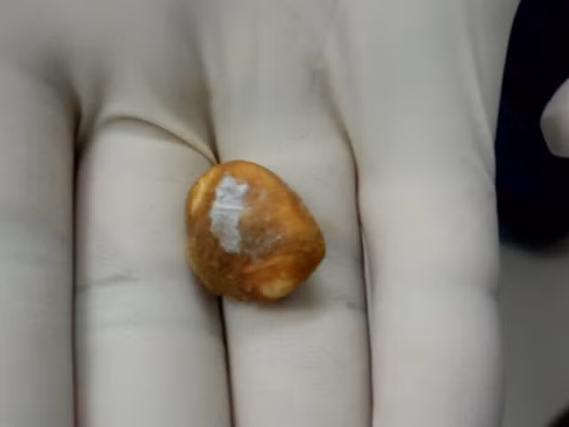 Hạt măng cụt trong dạ dày bệnh nhân nữ sắp nảy mầm Hạt măng cụt trong dạ dày bệnh nhân nữ sắp nảy mầm
