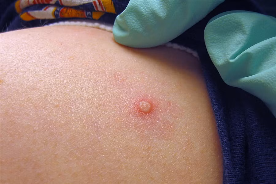 Việt Nam ghi nhận ca mắc đậu mùa khỉ thứ 2. Ảnh nguồn internet Việt Nam ghi nhận ca mắc đậu mùa khỉ thứ 2. Ảnh nguồn internet