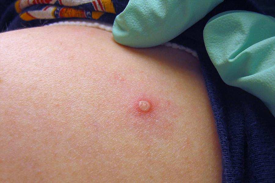 Việt Nam ghi nhận ca mắc đậu mùa khỉ thứ 2. Ảnh nguồn internet