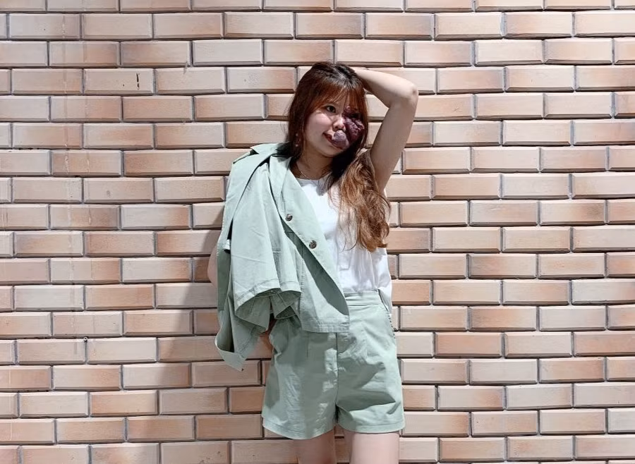  Nga không may mắn khi bị u máu bẩm sinh. Ảnh: NVCC