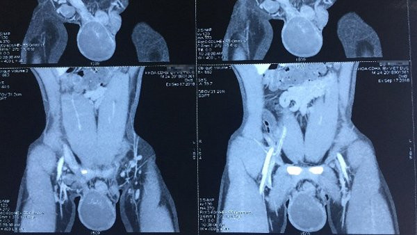  Hình ảnh khối u trên tinh hoàn phải của bệnh nhân