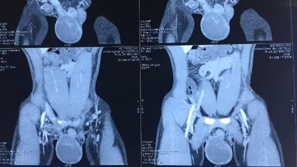  Hình ảnh khối u trên tinh hoàn phải của bệnh nhân