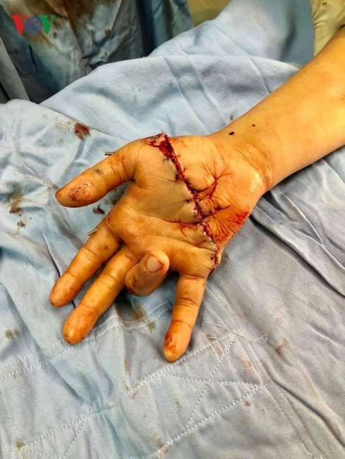 Bàn tay đứt lùa của chị Vũ Thị Ét sau khi được nối lại