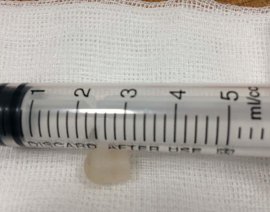 Đầu bút chì rơi vào phế quản phải nạn nhân gây tím tái, suy hô hấp. Ảnh: Chí Hào Đầu bút chì rơi vào phế quản phải nạn nhân gây tím tái, suy hô hấp. Ảnh: Chí Hào