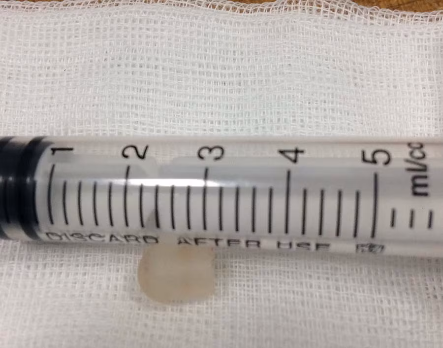 Đầu bút chì rơi vào phế quản phải nạn nhân gây tím tái, suy hô hấp. Ảnh: Chí Hào