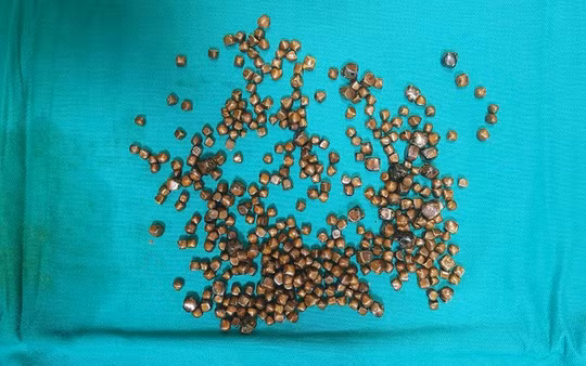 Gần 400 viên sỏi được lèn chặt trong túi mật của bệnh nhân được gắp ra ngoài - Ảnh: Thanh Xuân