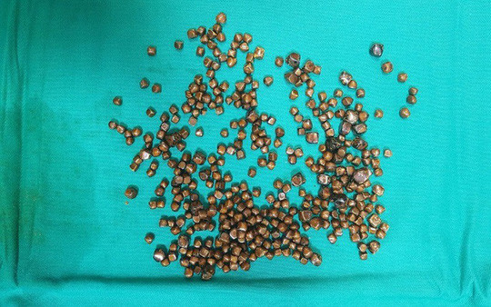 Gần 400 viên sỏi được lèn chặt trong túi mật của bệnh nhân được gắp ra ngoài - Ảnh: Thanh Xuân Gần 400 viên sỏi được lèn chặt trong túi mật của bệnh nhân được gắp ra ngoài - Ảnh: Thanh Xuân