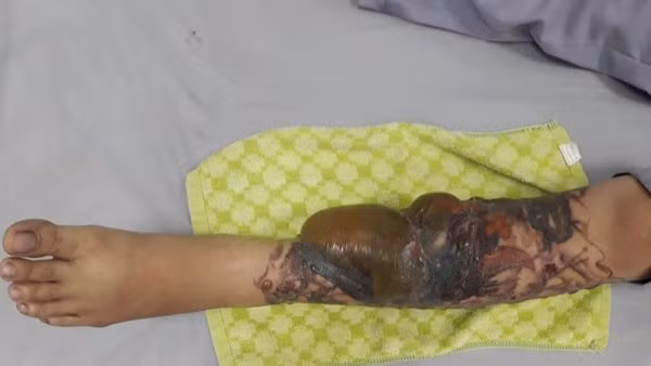  Bệnh nhân bị bỏng nặng sau xoá xăm bằng laser