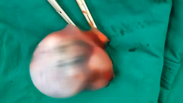 Khối u ác tính được lấy ra Khối u ác tính được lấy ra