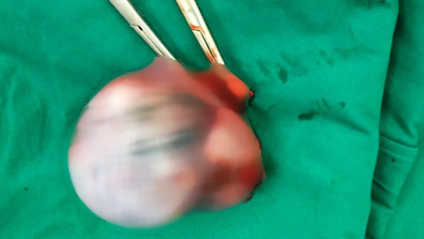 Khối u ác tính được lấy ra