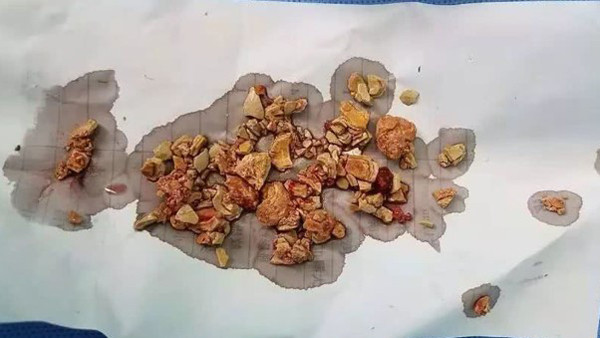 Phần sỏi được lấy ra 