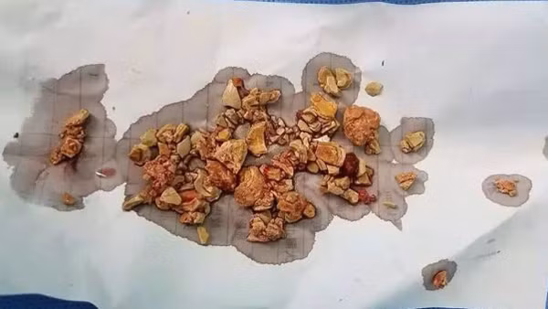 Phần sỏi được lấy ra 