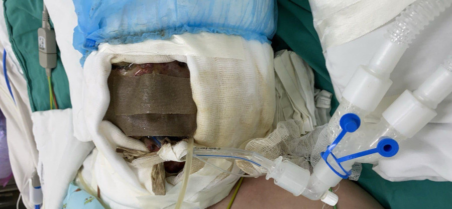 Tình trạng của bệnh nhi bị bỏng rất nặng. Ảnh: Bệnh viện Nhi đồng 2