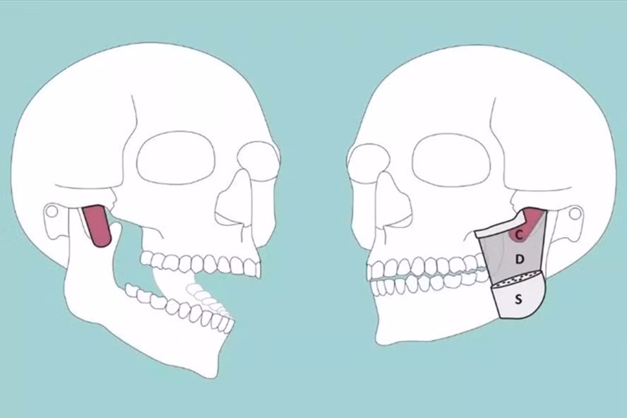 Bộ phận mới của cơ thể người vừa được phát hiện là lớp cơ chạy từ sau xương gò má đến cơ trước của hàm dưới (lớp D). Ảnh: Đại học Basel