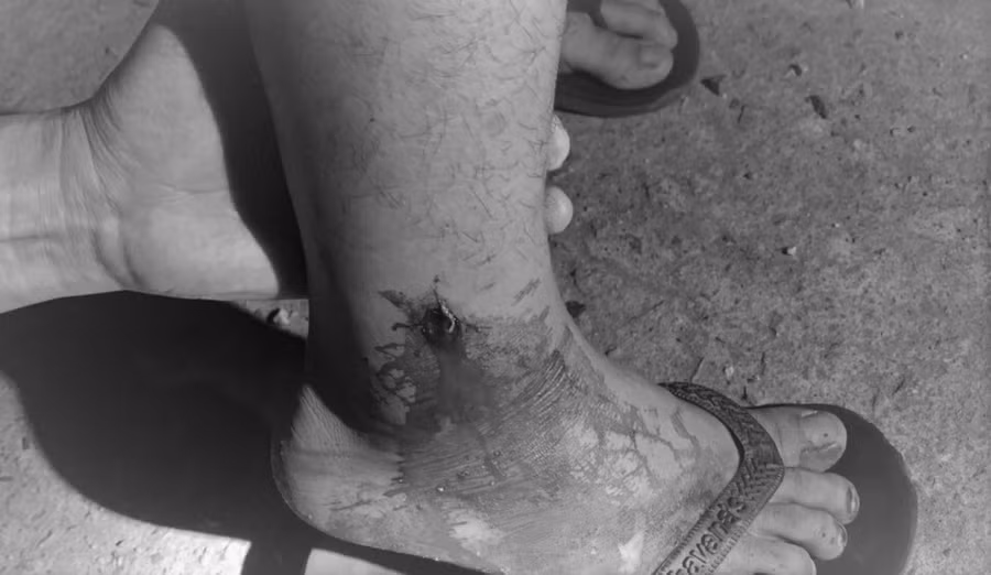  Viên đạn bắn trúng chân một thanh niên.