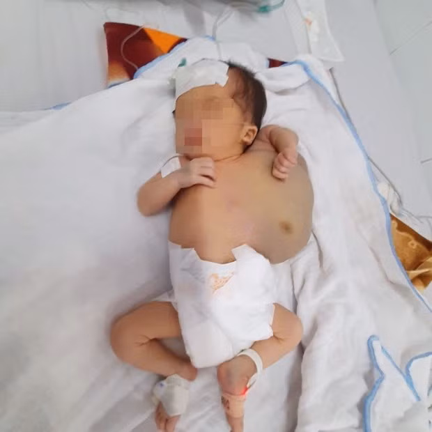 Bệnh nhi với khối u nặng hơn 1kg. Ảnh: PV/Vietnam+