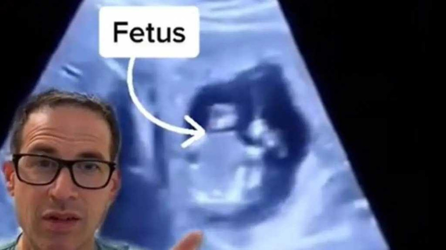 Hình ảnh của bào thai đang phát triển trong gan người phụ nữ, được bác sĩ Michael Narvey đăng trên Tik Tok - Ảnh: Shutterstock Hình ảnh của bào thai đang phát triển trong gan người phụ nữ, được bác sĩ Michael Narvey đăng trên Tik Tok - Ảnh: Shutterstock