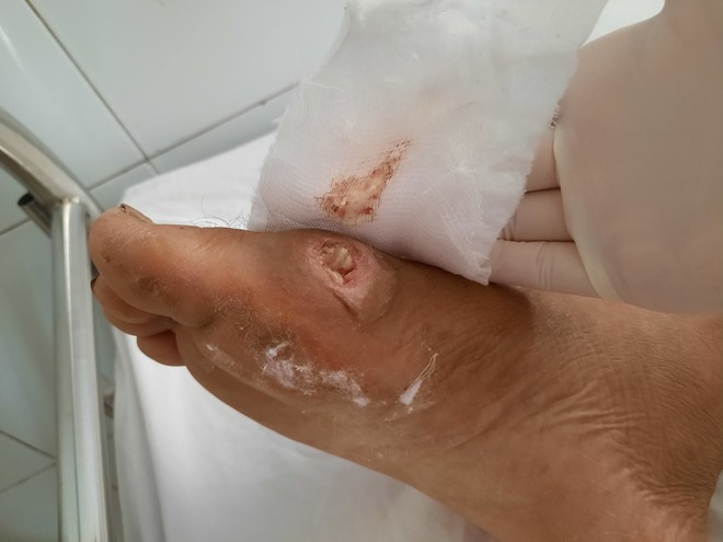 Vết hoại tử trên da ở một BN Whitmore đang được điều trị tại Khoa Y học nhiệt đới (BV Đà Nẵng) ẢNH: AN QUÂN