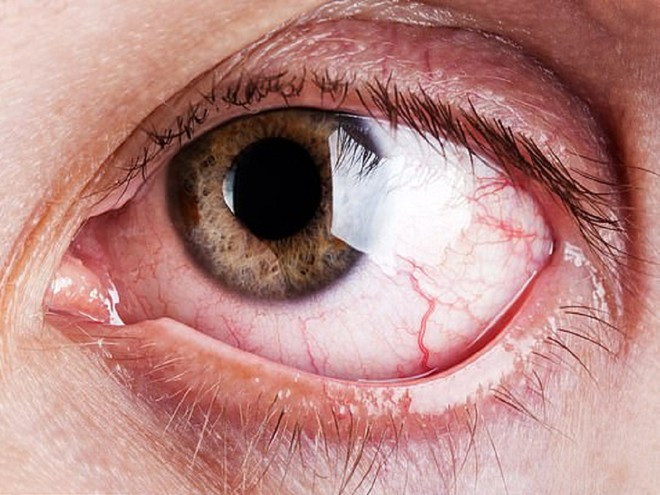 Các bác sĩ đã gắp gần 20 con giun ký sinh từ mắt ông Vạn ở Trung Quốc. ẢNH MINH HỌA: SHUTTERSTOCK