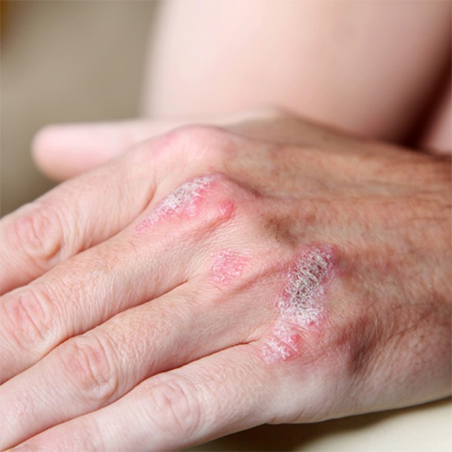 Tiêu thụ trà xanh có liên quan đến việc giảm các tổn thương do bệnh vảy nến ẢNH: SHUTTERSTOCK