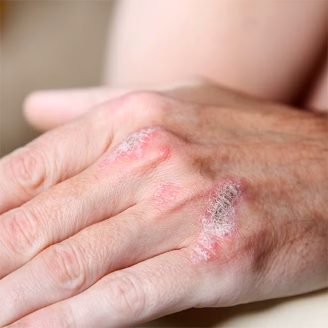 Tiêu thụ trà xanh có liên quan đến việc giảm các tổn thương do bệnh vảy nến ẢNH: SHUTTERSTOCK