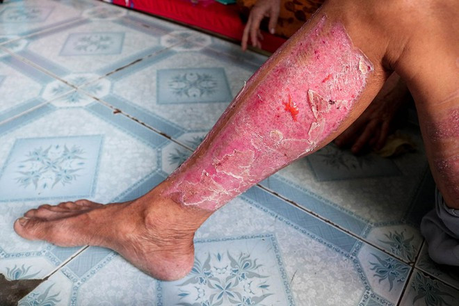 Ông Công cho da ở vùng bắp chân mình cho con trai trong lần phẫu thuật thứ hai