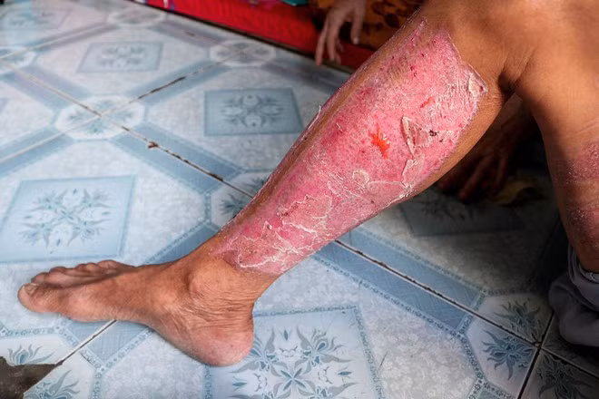 Ông Công cho da ở vùng bắp chân mình cho con trai trong lần phẫu thuật thứ hai