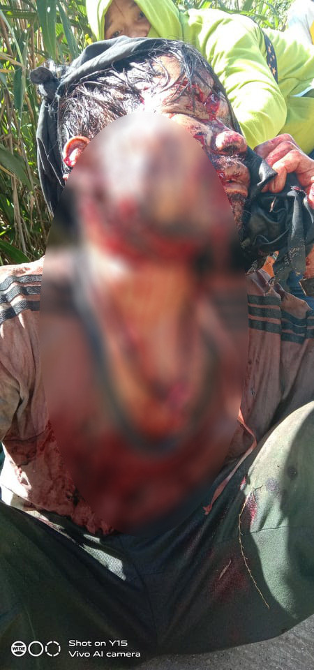 Nạn nhân Hội bị gấu tấn công nguy kịch. Ảnh: Hoàng Thọ