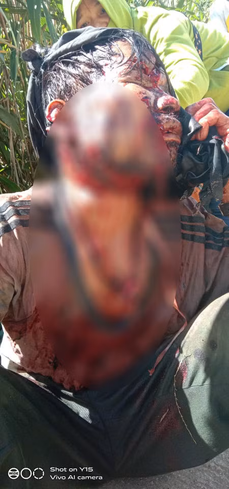 Nạn nhân Hội bị gấu tấn công nguy kịch. Ảnh: Hoàng Thọ