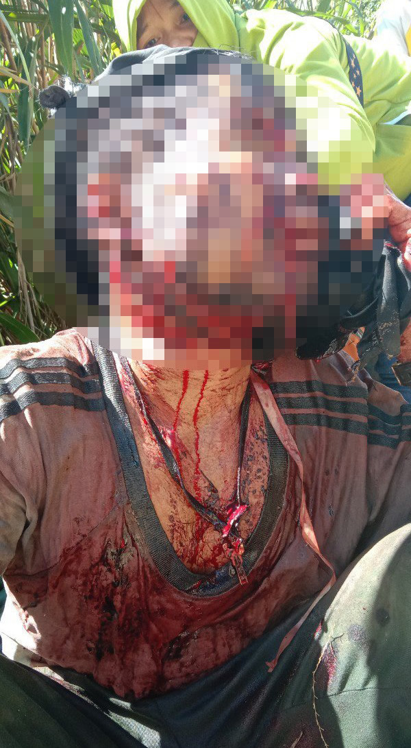 Anh Hồ Văn Hội với nhiều vết thương khắp người do gấu rừng tấn công. Anh Hồ Văn Hội với nhiều vết thương khắp người do gấu rừng tấn công.