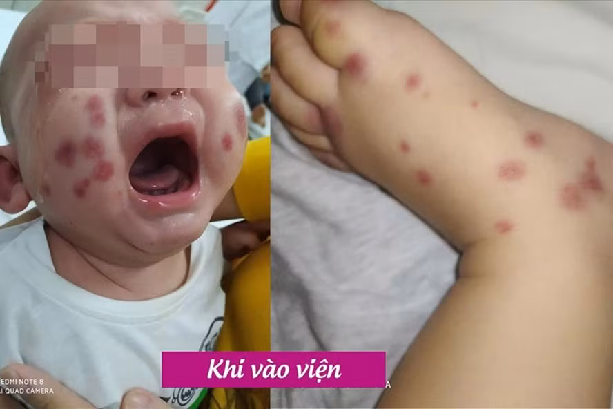 Bé trai mắc căn bệnh chưa từng được ghi nhận trong y văn Việt Nam. Ảnh: BVCC