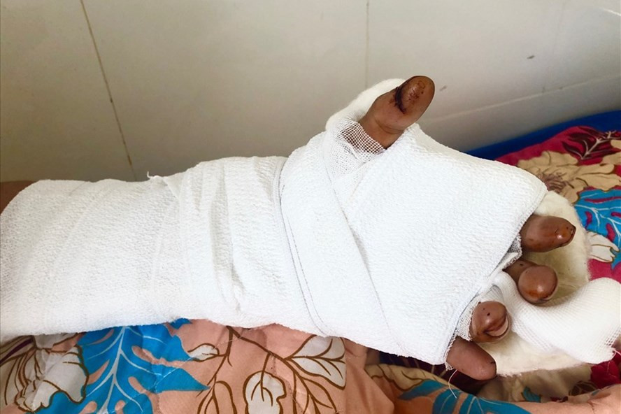 Bàn tay đứt lìa được nối thành công.